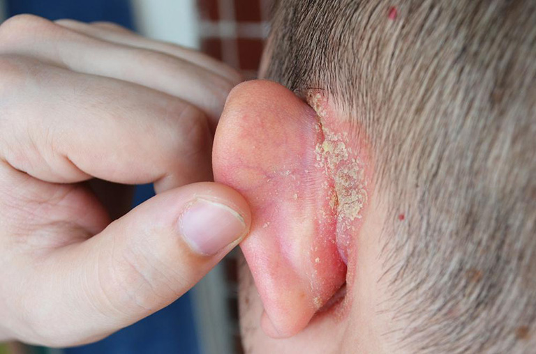 Vệ sinh tai không đúng cách có thể gây ra viêm vành tai